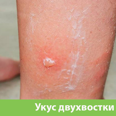 Укус двухвостки в Асбесте