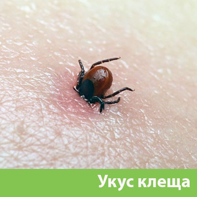 Укус клеща в Асбесте
