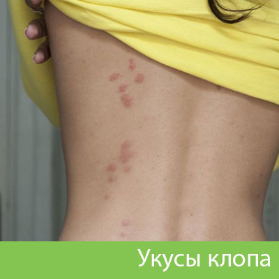 Профессиональное уничтожение клопов в Асбесте